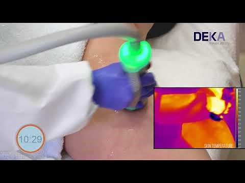 ONDA by DEKA - Cellulite Treatment Tutorial