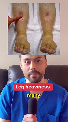 Foot doctor explains the feeling of leg heaviness as a symptom of swollen ankles. #podiatrist #podiatry #legs #feet #edema | The Good Foot Doctor