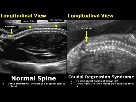 Fetal Spine Ultrasound Normal Vs Abnormal Image Appearances | Spinal Abnormalities | Obstetric USG