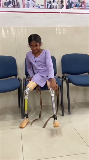 Artificial leg above knee prosthesis leg / best use artificial leg / #shortsfeed #hassanzarar