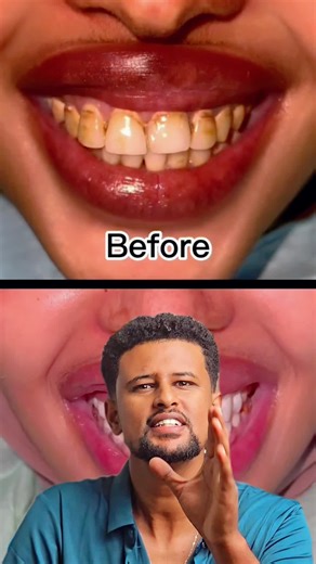 Teeth Whitening with Lanbena Products