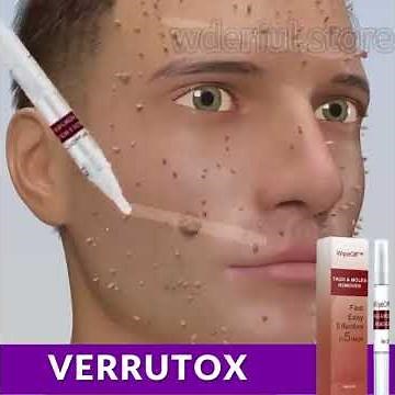 Como Remover Verrugas? Verrutox Original