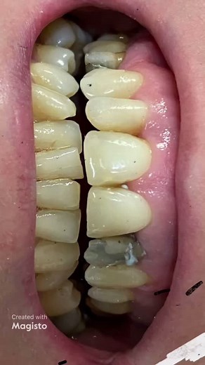 #dentist #teeth #cosmetics #transformation #beforeandafter #dental #viral #learnontiktok #tiktokromania #veneers #dentalcrown #odontologia #doctor #y