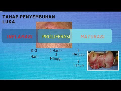 Mengobati Luka Bakar : Tahap Penyembuhan Luka Bakar