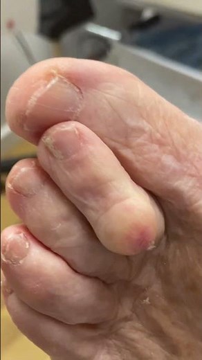 Corn vs Ulcer: 2nd Toe Transformation Update! #ToeCare #FootHealth