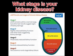 What Your eGFR Number Means (CKD Stages) S1 (Normal/High): eGFR >90, but with other signs of kidney damage. S2 (Mildly Decreased): eGFR 60-89, with other signs of damage. S3a (Mild-Moderate): eGFR 45-59. S3b (Moderate-Severe): eGFR 30-44. S4 (Severe Decrease): eGFR 15-29 (referral to specialist needed). S5 (Kidney Failure): eGFR