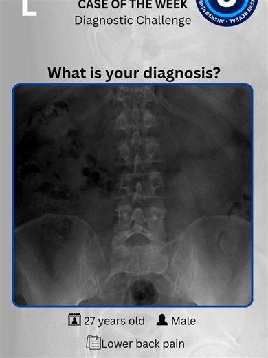 Spondylolytic Spondylolisthesis of L5 (Grade 1) with Bilateral Pars Defects This case demonstrates a low-grade (Grade 1) anterior slippage of L5 over S1, associated with bilateral pars interarticularis defects (spondylolysis). The lateral lumbar radiograph shows disruption of the pars with mild vertebral translation and accompanying degenerative disc changes. Spondylolytic spondylolisthesis is commonly seen in adolescents and young adults, often related to repetitive stress or extension injuries