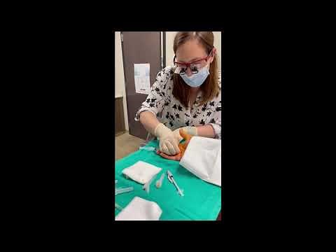 Treating Dupuytren’s Contracture With Dr. Kathleen Kollitz