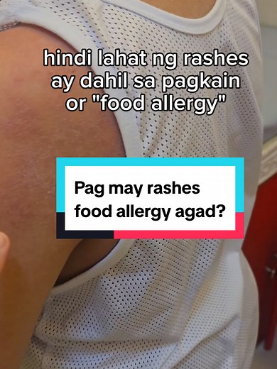 ❗️Not all rashes are food allergies. As a pediatrician, most rashes I see are actually viral exanthems — and very often, eczema (atopic dermatitis). Hindi lahat kailangan ng food restriction or allergy testing. Here’s how to tell the difference and what parents should do 👇 🦠 VIRAL EXANTHEM (viral rash) Common during cough, colds, flu, HFMD, NSVE Usually appears after or during fever and spreads over the body. Treatment: ✔️ No antibiotics needed (viral ito) ✔️ Fluids rest ✔️ Paracetamol for fev