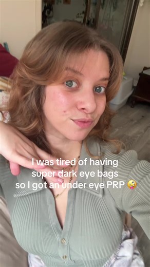 Of course when I filmed the first part of the video my eye bags weren’t that bad but I was always self conscious of them being super dark always. I have to go back for another session or two but it’s so been worth it imo🕺🏼