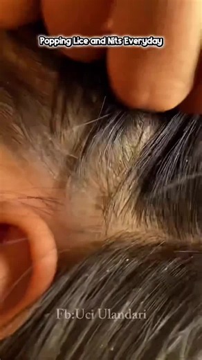 Effective Lice Removal: How to Get Rid of Ticks & Lice