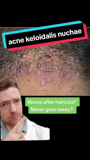 AKN cannot be managed by home remedies like acids, motor oil, washes, etc. These can further damage your skin and make this condition worse in the long run. A dermatologist can help keep this chronic and potentially disfiguring condition manageable. #greenscreen #doctorsoftiktok #dermatology #doctor #dermtok #resident #hair #akn #acnekeloidalisnuchae