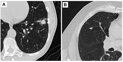 FDA Issues 510(k) Clearance of AI-Powered Assessment for Lung Cancer on Low-Dose CT Scans | Diagnostic Imaging