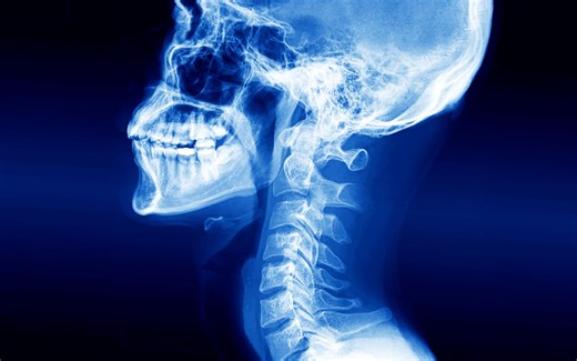 一位男性不慎咽下了无线耳机，这是他的食道发生的变化