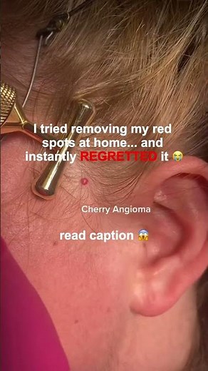 I tried removing my CHERRY ANGIOMAS at home... and instantly REGRETTED it 😭