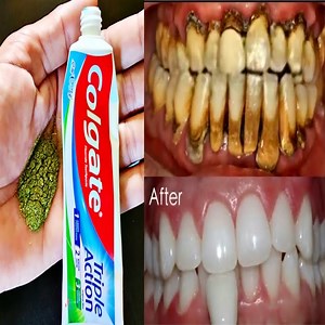 Toothpaste with bay leaf essential oil might be a breakthrough in oral hygiene products for teeth whitening by removing surface stains. This study provides new data on the development of bay leaf as an active agent to replace chemical active agents and abrasives in toothpaste with acceptable efficacy. | ELEGANT BEAUTY