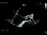Mitral Valve Regurgitation • Video • MEDtube.net