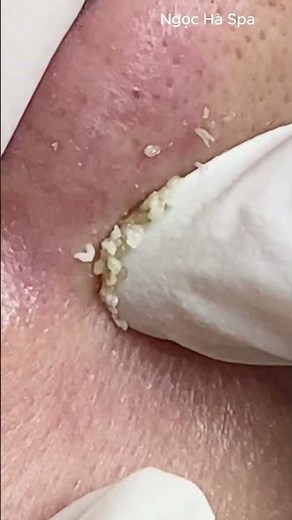 Nose Blackhead Removal | Relaxing ASMR || Ngọc Hà Spa