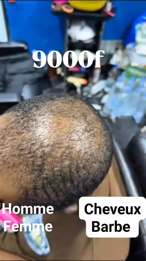 🚨🚨 𝐏𝐑𝐎𝐌𝐎: 𝟗𝟎𝟎𝟎𝐟 𝐅𝐢𝐧𝐢 𝐚𝐯𝐞𝐜 𝐥𝐞𝐬 𝐩𝐫𝐨𝐛𝐥𝐞̀𝐦𝐞 𝐝𝐞 𝐜𝐡𝐞𝐯𝐞𝐮𝐱 𝐪𝐮𝐢 𝐭𝐨𝐦𝐛𝐞𝐧𝐭, 𝐥𝐚 𝐜𝐚𝐥𝐯𝐢𝐭𝐢𝐞, 𝐥𝐞𝐬 𝐛𝐥𝐚𝐧𝐜𝐡𝐢𝐬𝐬𝐞𝐦𝐞𝐧𝐭 𝐝𝐞𝐬 𝐜𝐡𝐞𝐯𝐞𝐮𝐱 𝐇𝐨𝐦𝐦𝐞 𝐅𝐞𝐦𝐦𝐞 Prends ton traitement pour finir avec ce problème. 𝐀𝐕𝐀𝐍𝐓𝐀𝐆𝐄𝐒 . Produit Naturel .Suivi traitement . Satisfaction appartir du 17ème jour. . Facile à utiliser . Sans effet secondaire. 𝐍𝐁: 𝐮𝐧𝐢𝐪𝐮𝐞𝐦𝐞𝐧𝐭 𝐩𝐨𝐮𝐫 𝐥𝐞𝐬 𝟏𝟎 𝐩𝐫𝐞𝐦𝐢𝐞𝐫𝐬 𝐩𝐞𝐫𝐬𝐨𝐧𝐧𝐞𝐬. Contact 