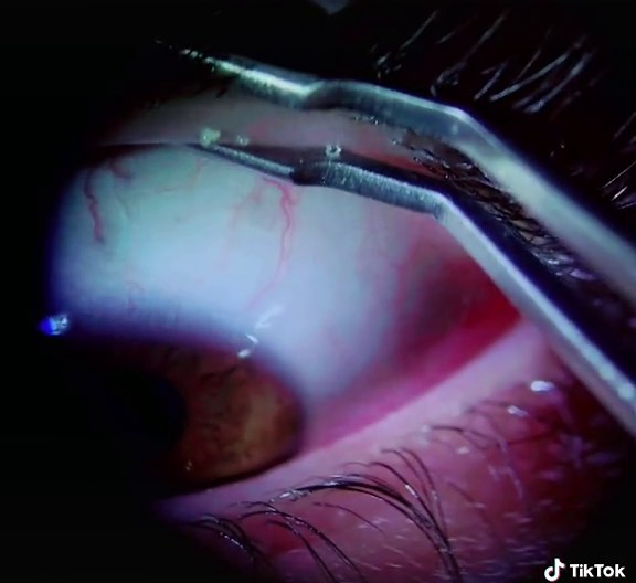 Eye Oil Gland Expression and Pimple Popping Guide