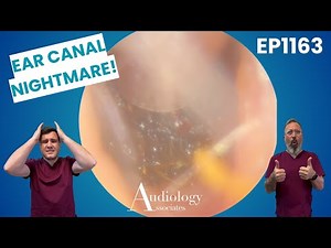 Extreme Ear Wax Removal | Narrow Canal Challenge! - EP1163