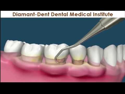 Professionelle Zahnreinigung, Diamant-Dent Zahnklinik