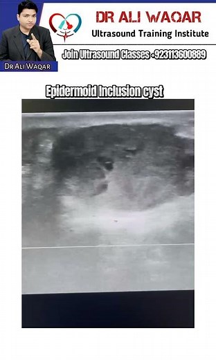Epidermoid Inclusion cyst in ultrasound