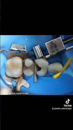 Caries Interproximales, Elevación de Márgenes profundos, resinas compuestas clase II, Biomimetics