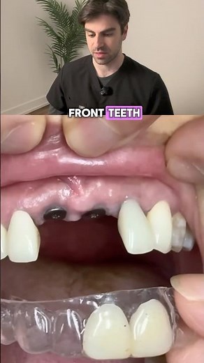 Fixing Missing Front Teeth (Temporary FIX)