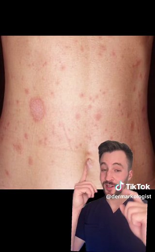 Pityriasis Rosea: Rash That Looks Like Ringworm