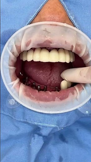 전체임플란트 수술당일 임시치아 #dentist #dentistry #dentalprosthesis #implants