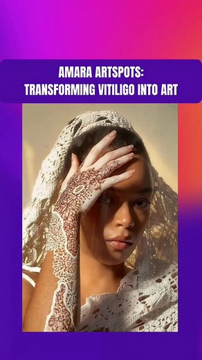 Beauty painted on unique canvases 🎨 Amara Artspots celebrates vitiligo by transforming skin's natural patterns into artistic canvases—applying body art that enhances rather than conceals the condition's distinctive appearance. This movement redefines beauty standards by proving that skin conditions become opportunities for creative expression when society shifts from hiding differences to highlighting them as art. #AmaraArtspots #Vitiligo #BodyArt #BeautyRedefined #SkinPositivity #BodyPositivit