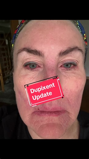 Dupixent y sus efectos secundarios en la salud ocular