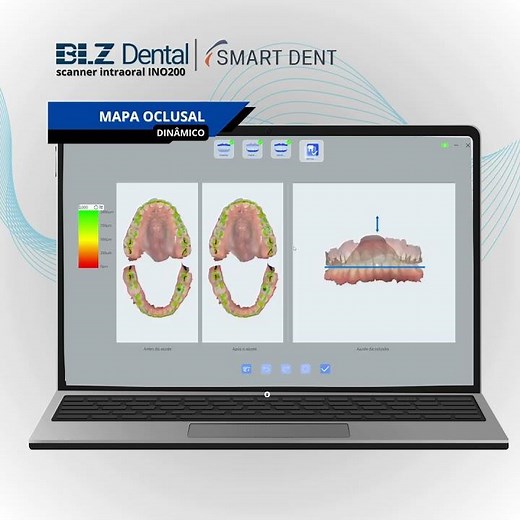 ✨ REGISTRO OCLUSAL PRECISO EM SEGUNDOS! 🚀