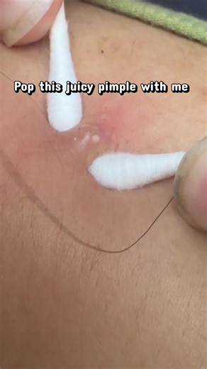 What tool do you use to pop pimples?? #pimplepopping #pimplepopper | pop