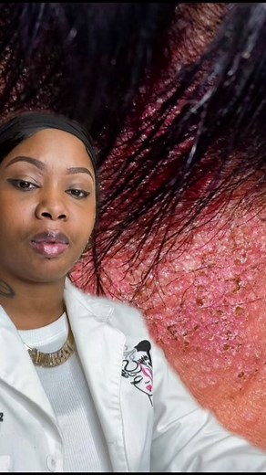 Psoriasis vs Seborrheic Dermatitis: Understanding the Key Differences