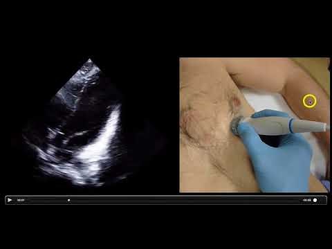 Optimizing Cardiac Views with Ultrasound