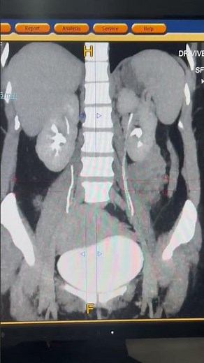 Duplex collecting System 💯 #kidney #radiology #ctscan #shorts #ytshorts
