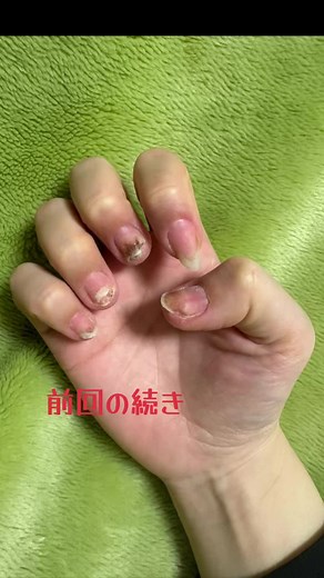 後半のジェルアレルギー対策と注意点