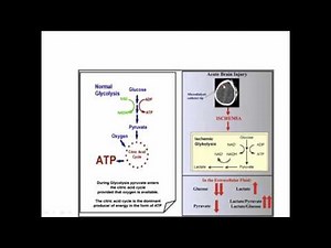 Cerebral Microdialysis