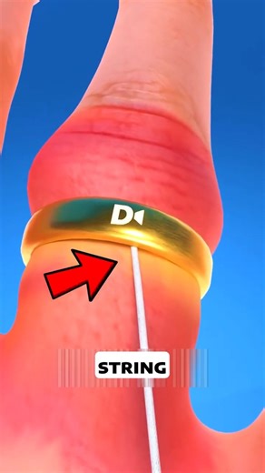 Stuck Ring? This Trick Could Save Your Finger! 😬