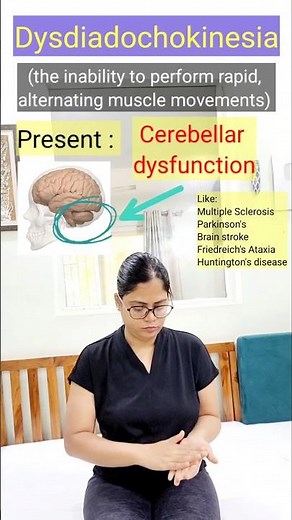 Dysdiadochokinesia | Cerebellar dysfunction #neurology #brainlesion