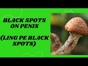 Black spots on the penis (melanosis)
