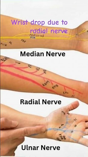 Wrist Drop Due to Radial Nerve Injury | Causes, Symptoms & Physiotherapy Exercises
