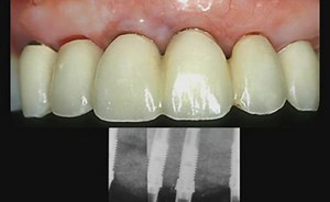 Vertical ridge augmentation using alveolar distraction osteogenesis (DO)