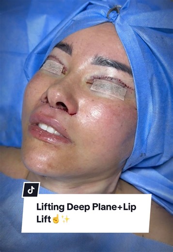 ✨Lifting Deep Plane Lip Lift✨ Una combinación que rejuvenece el rostro de forma natural, reposicionando los tejidos en profundidad y elevando el labio para devolver frescura, armonía y definicion☝️😎 👉Para más información contáctanos 51 967 310 393 📍San Borja, Lima-Perú #lifting #liftingfacial #liplift #glowup #lima