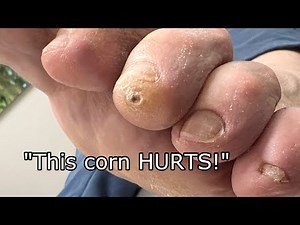 🌽 Hammer Toes & Dry Skin Cause Painful Corns 🌽 Expert Treatment by Dr. Binh | Healthy Feet Podiatry