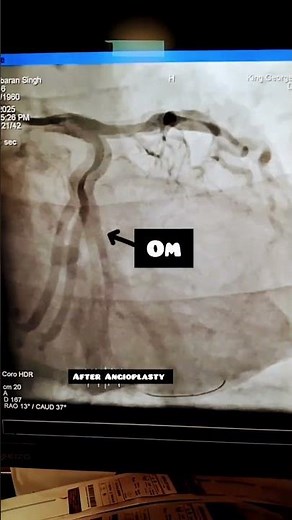 "OM 100% stenosis? watch it open up with PTCA!"