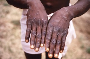 Monkeypox symptoms: The 7 early signs to look for