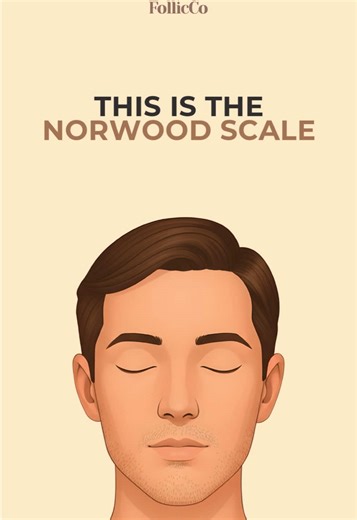 Understanding the Norwood Scale for Hair Loss